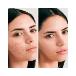 Crema facial hidratante, piel grasa y acné, con CBD, ecológica - Herbera Biocosmética